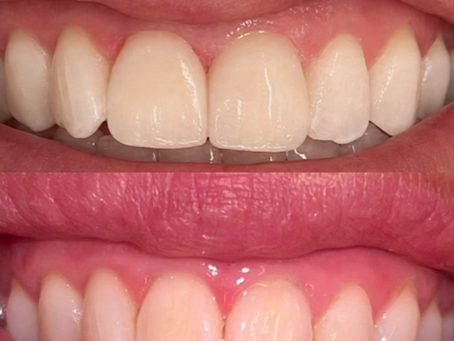 Anterior Veneer Restoration