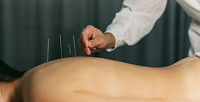 acupuncture-process.jpg