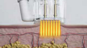 Example Skin Treatment
