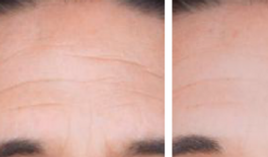 Before After Picturese Forhead