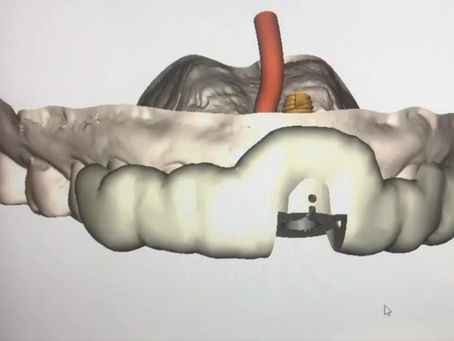 DENTAL STUDENT BLOG POST: Why are Implants my Best Option for Missing Teeth?