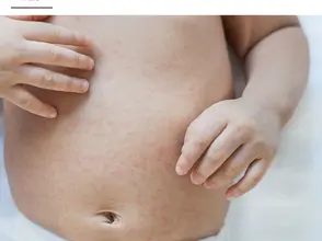 Heat Rash: What You Need to Know