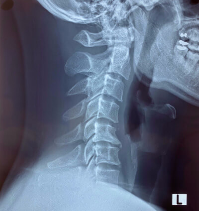 Reverse Cervical Lordosis reverse neck curve