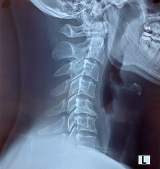 Reverse Cervical Lordosis Chiropractic Hong Kong