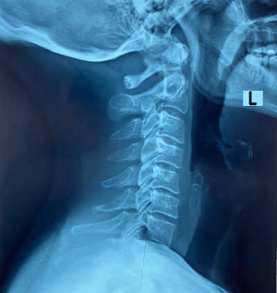 Cervical Hypolordosis straight neck