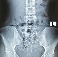 X-ray Patient B Pelvis