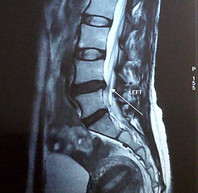 MRI Scan Patient D Lumbar