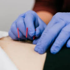 Close-up of Integrative Dry Needling treatment