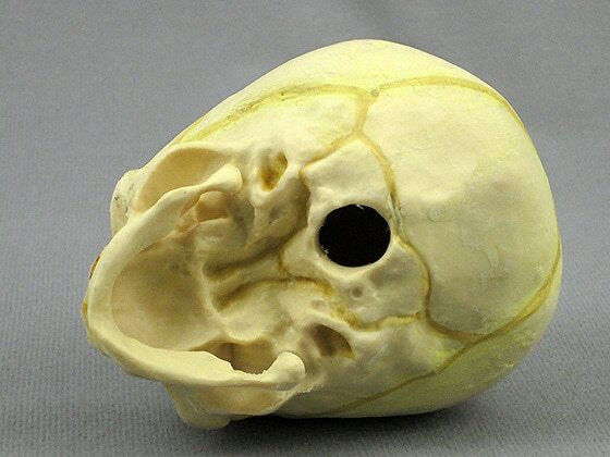 Thumbnail: Fetal Skull