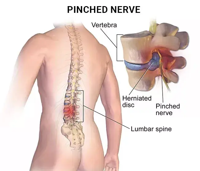 Understanding Pinched Nerves: What Every Patient Should Know