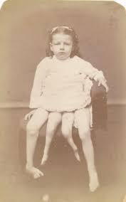 Myrtle Corbin was a 'dipygus', meaning she had two pelvises