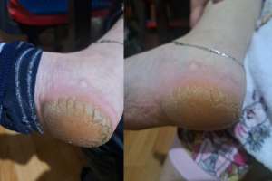 Cracked Heel Hell! - Our Solution!