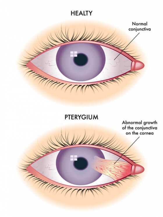 Ptergium