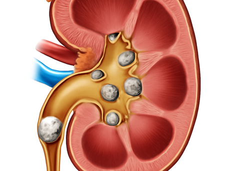Kidney stones
