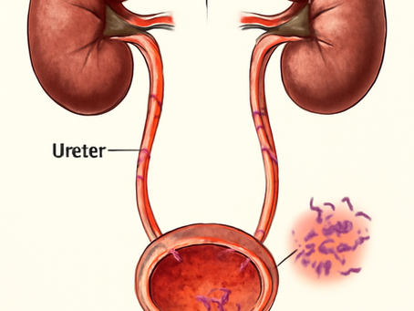 Urinary tract infection (UTI)
