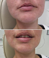 Young Female After Partial Denture