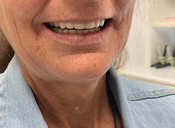 Full upper and lower dentures Female