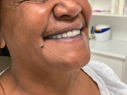 Full upper denture Female