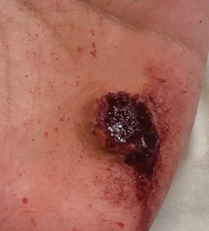 Gun Shot Wound