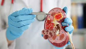 Your Kidneys Matter: Comprehensive Care at SNS Hospital's Nephrology Department