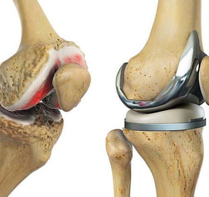 Total Knee Replacement (TKR)