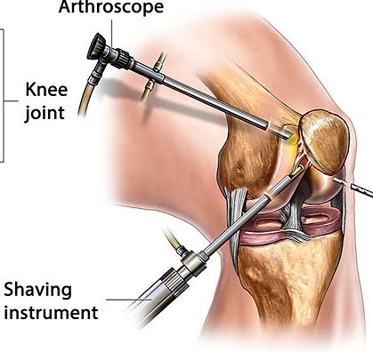 Arthroscopic Knee Surgery