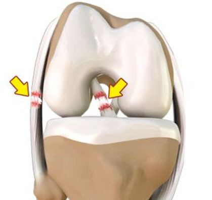 PCL And Multiple Ligament Injuries
