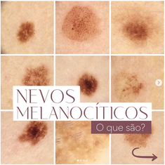 Nevos Melanocíticos, o que são?