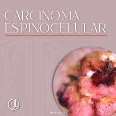 Carcinoma Espinocelular