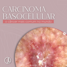 Carcinoma Basocelular: o câncer mais comum no mundo