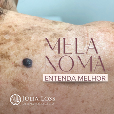Melanoma: entenda melhor