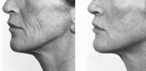 BIOREVITALIZATION PEEL 