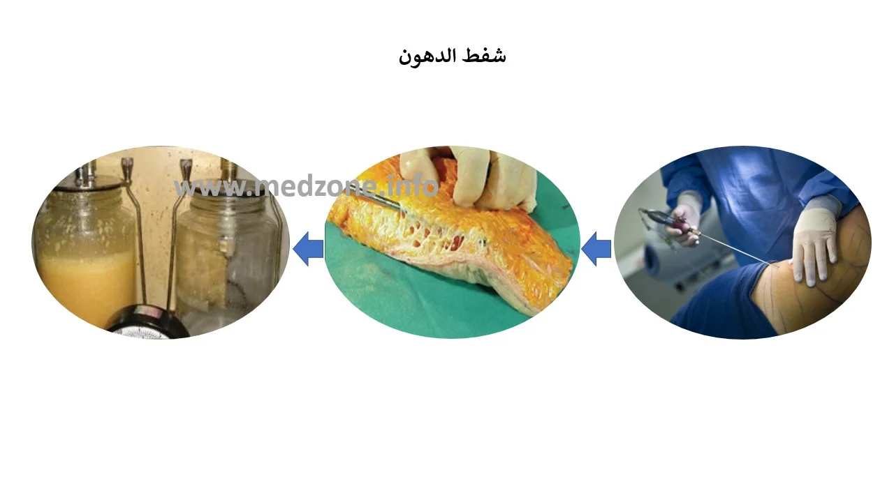 شفط الدهون