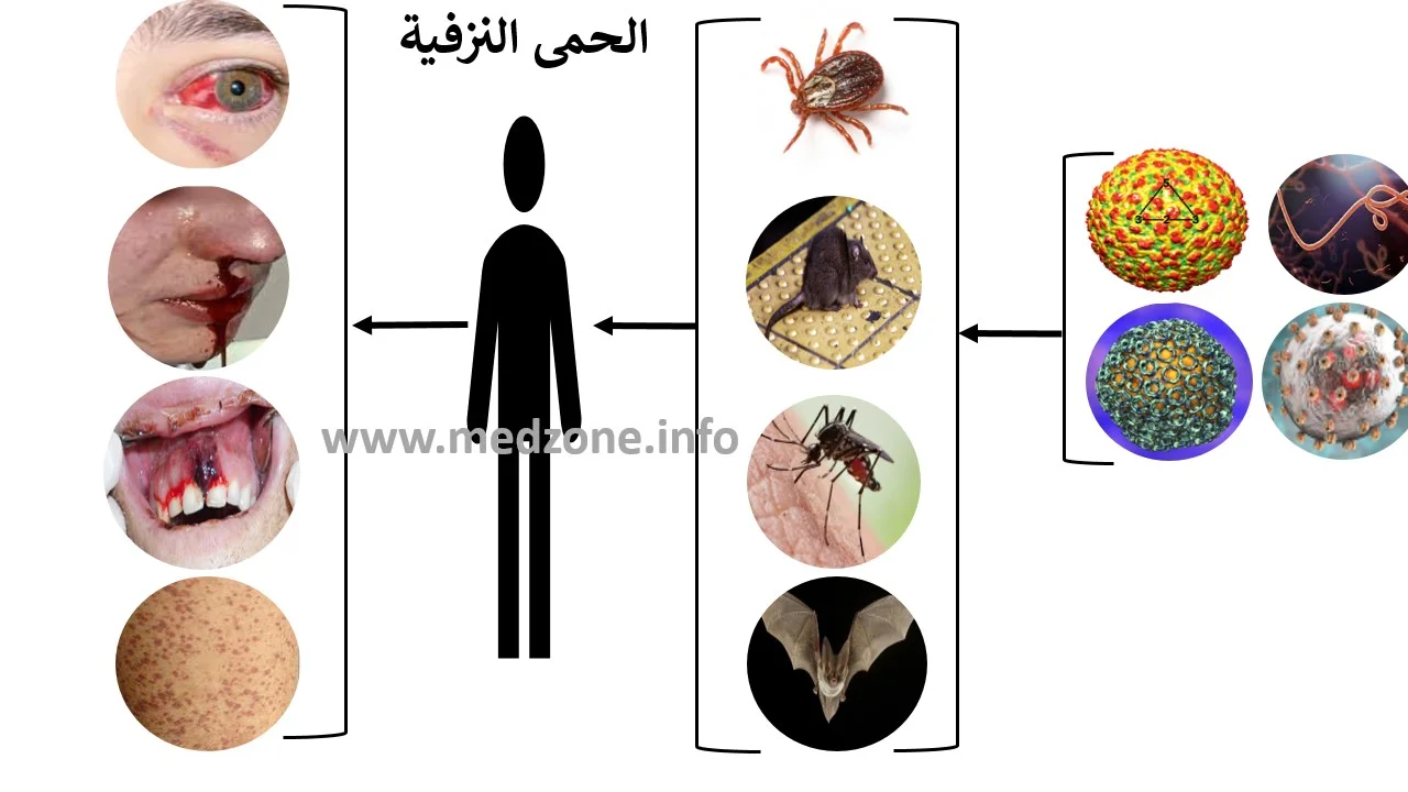 الحمى النزفية