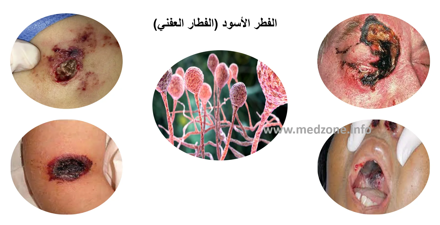 الفطر الأسود