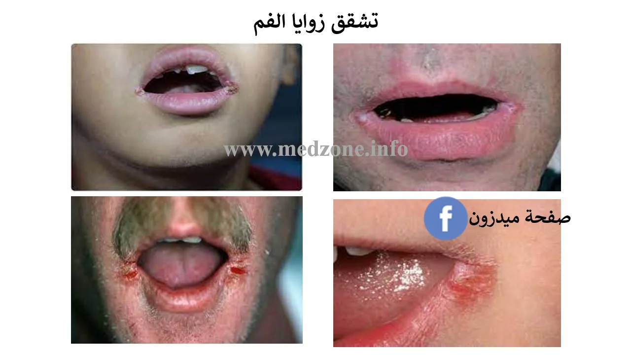 تشقق زوايا الفم