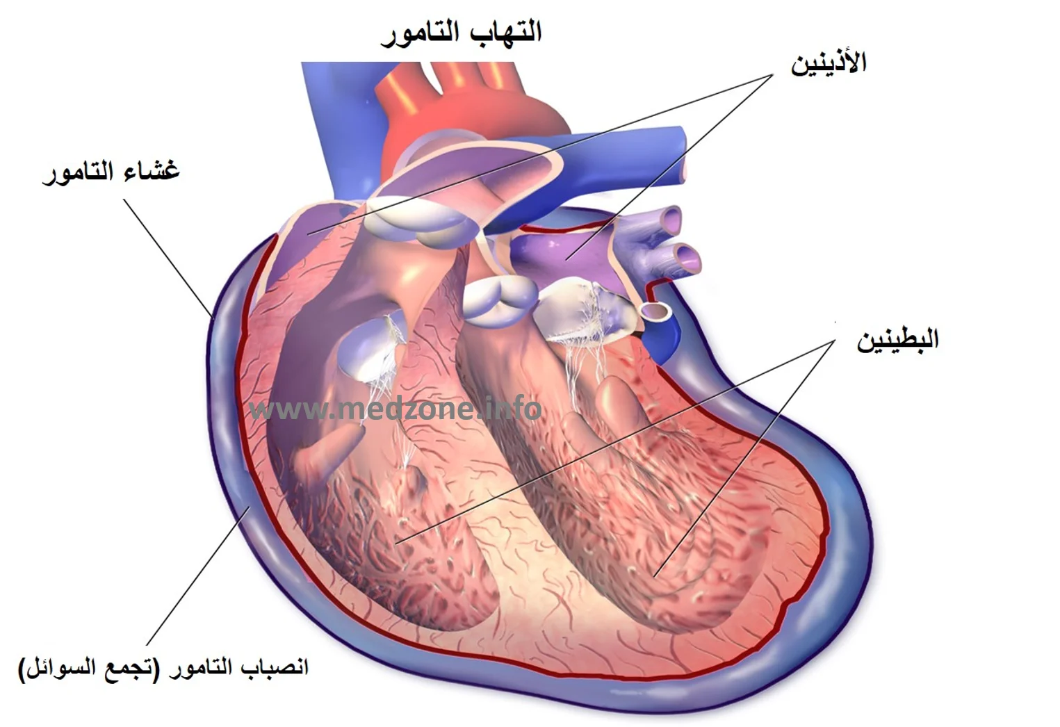 التهاب التامور