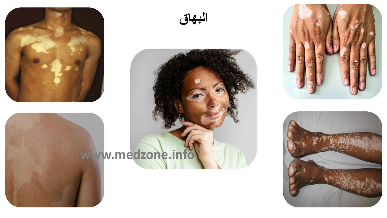 البهاق