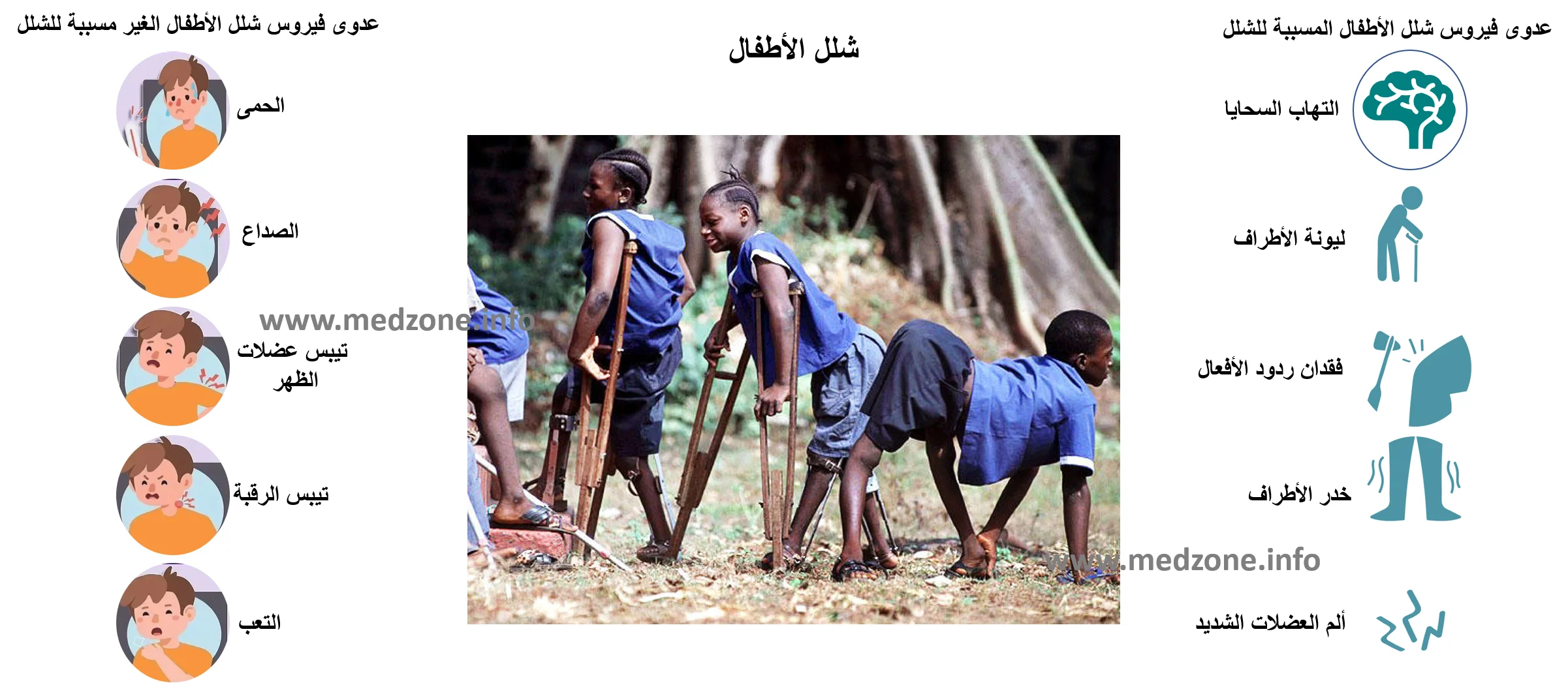 شلل الأطفال