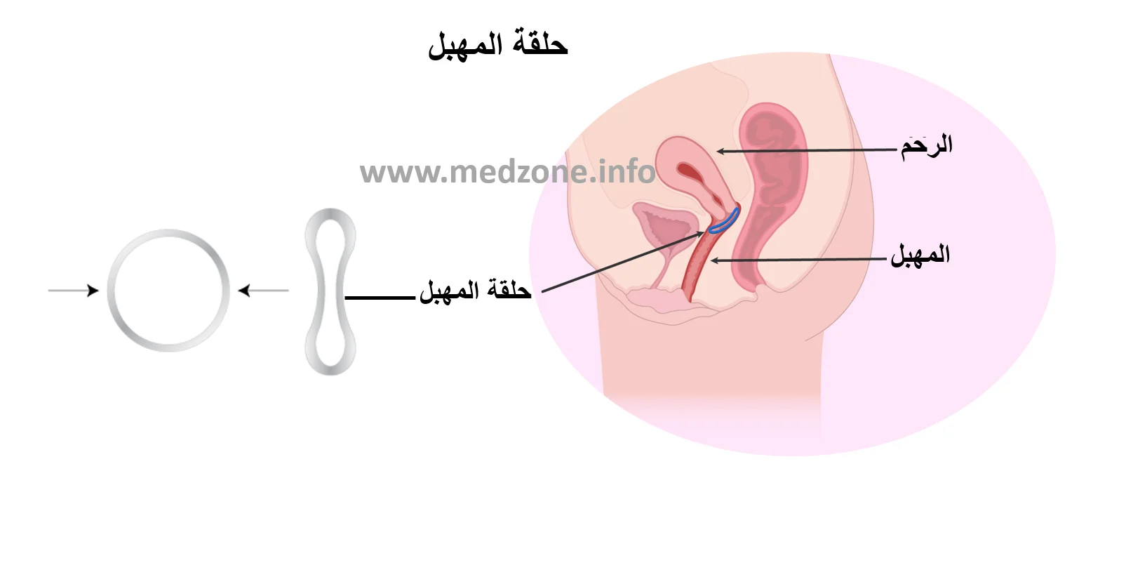 حلقة المهبل
