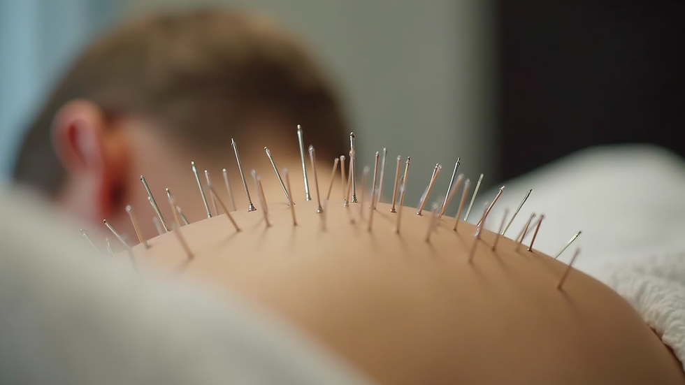 Close-up view of acupuncture needles placed on a patient’s back during treatment