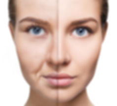 CIT, microneedling training, model showing before and after microneedling skincare treatment.