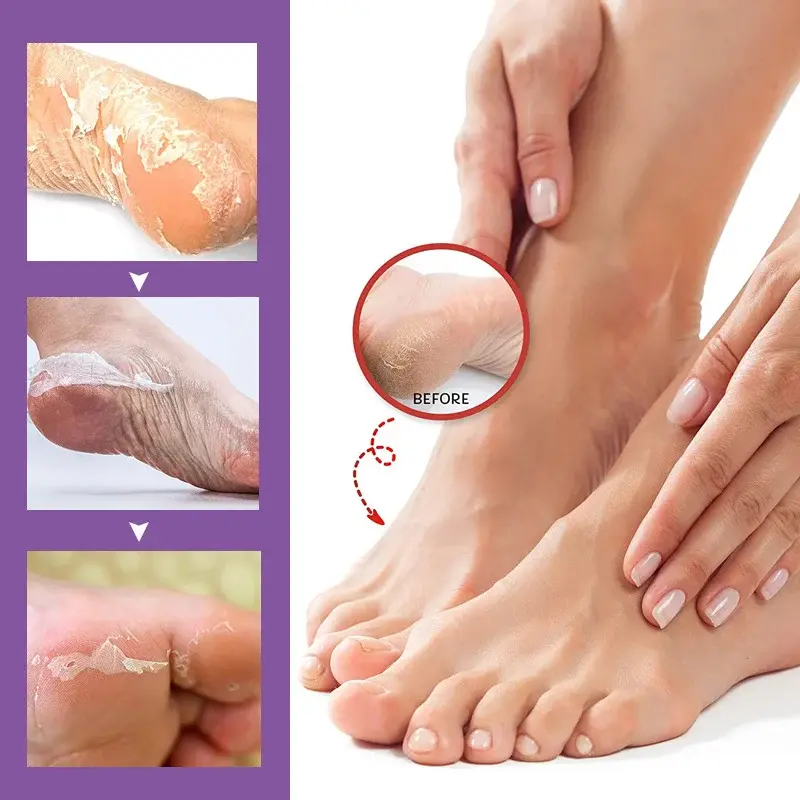 Thumbnail: 2-10pcs Exfoliating Foot Mask Foot for Remove Dead Skin Calluses Heel Crack