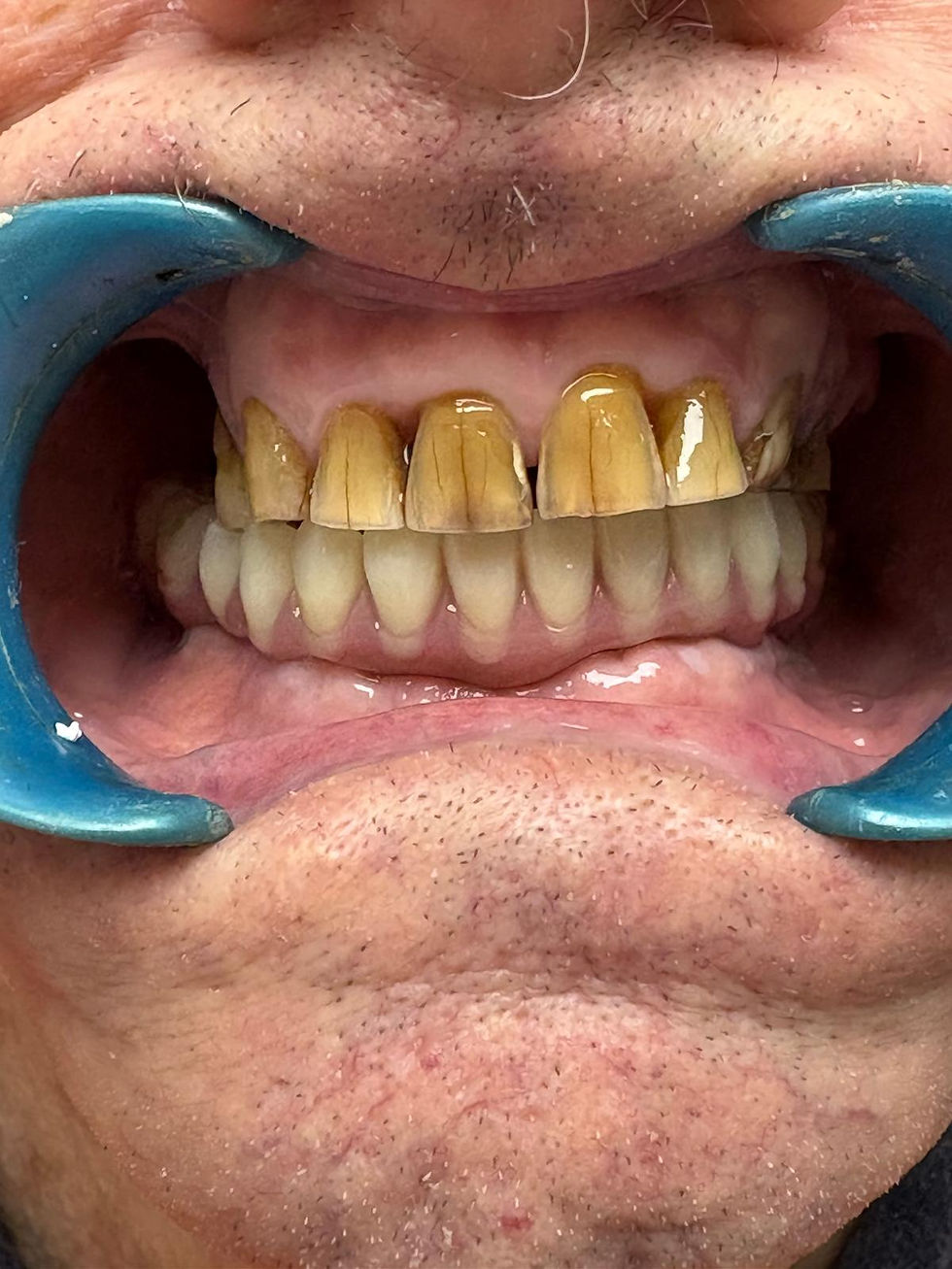 eliedental-cas4-implantation-immediate-03-apres.jpg
