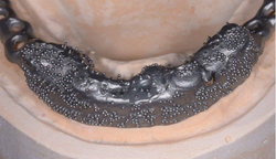 implant bar (2) prothèse dentaire POMLAB