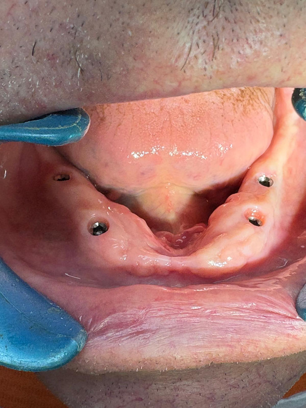 eliedental-cas4-implantation-immediate-01-avant.jpg