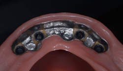 prothèse dentaire POMLAB