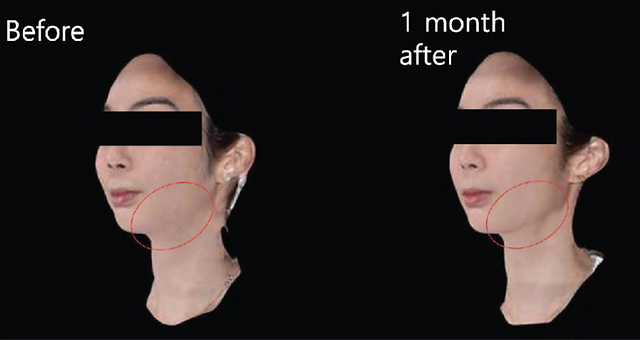 XTherma treatment result