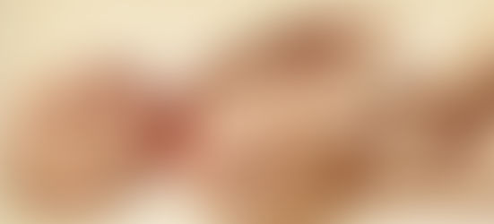 The Curious Case Files: Harlequin Ichthyosis (HI)