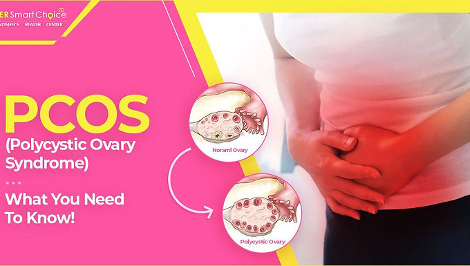 Features of PCOS